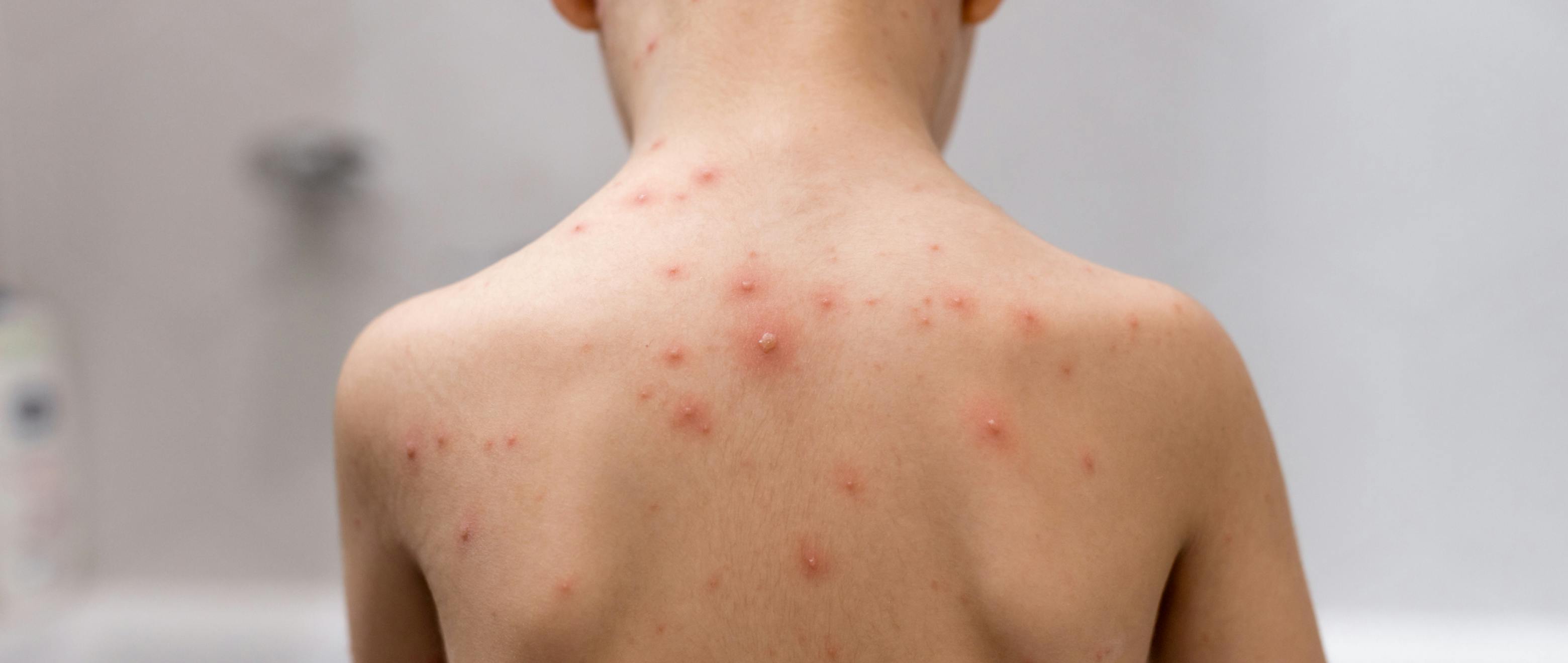 Don’t Get Ruffled: Spot Chickenpox Early