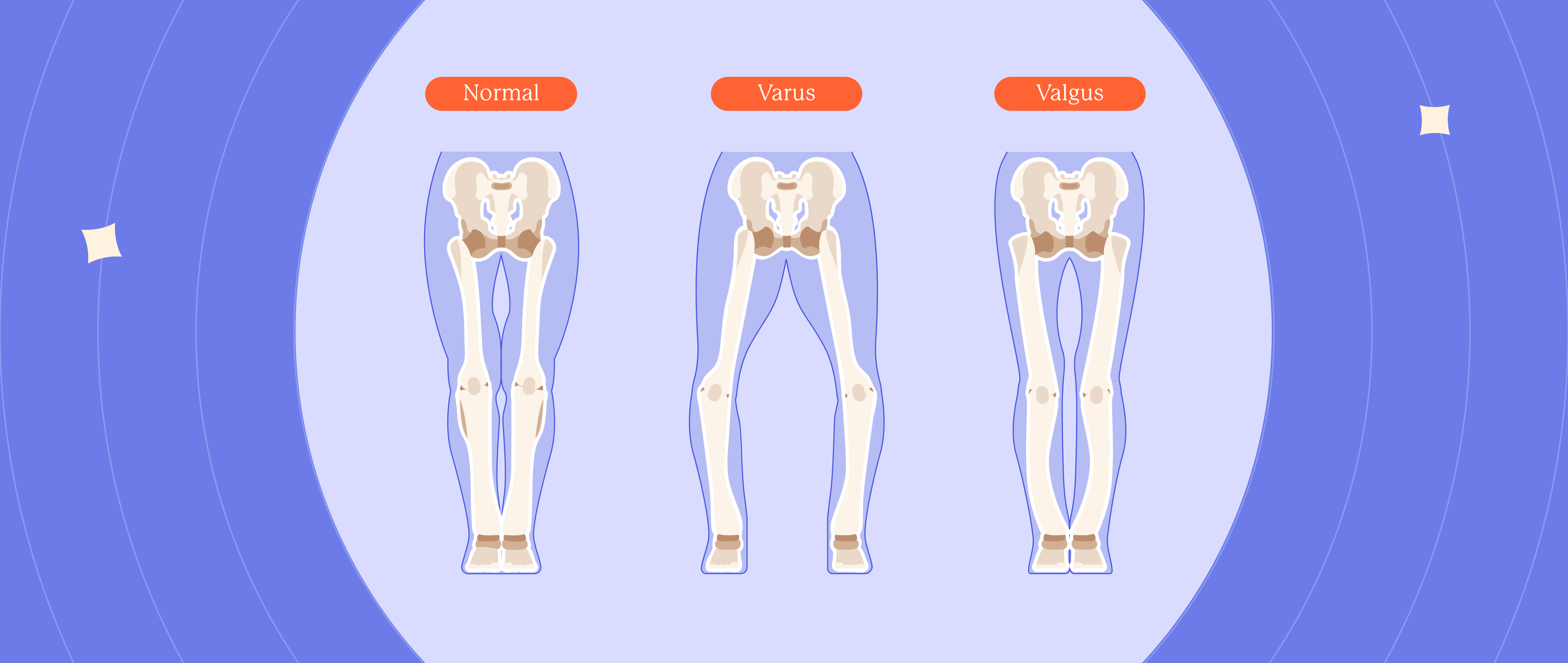 The Silent Bone Thief: Rickets in Children Today