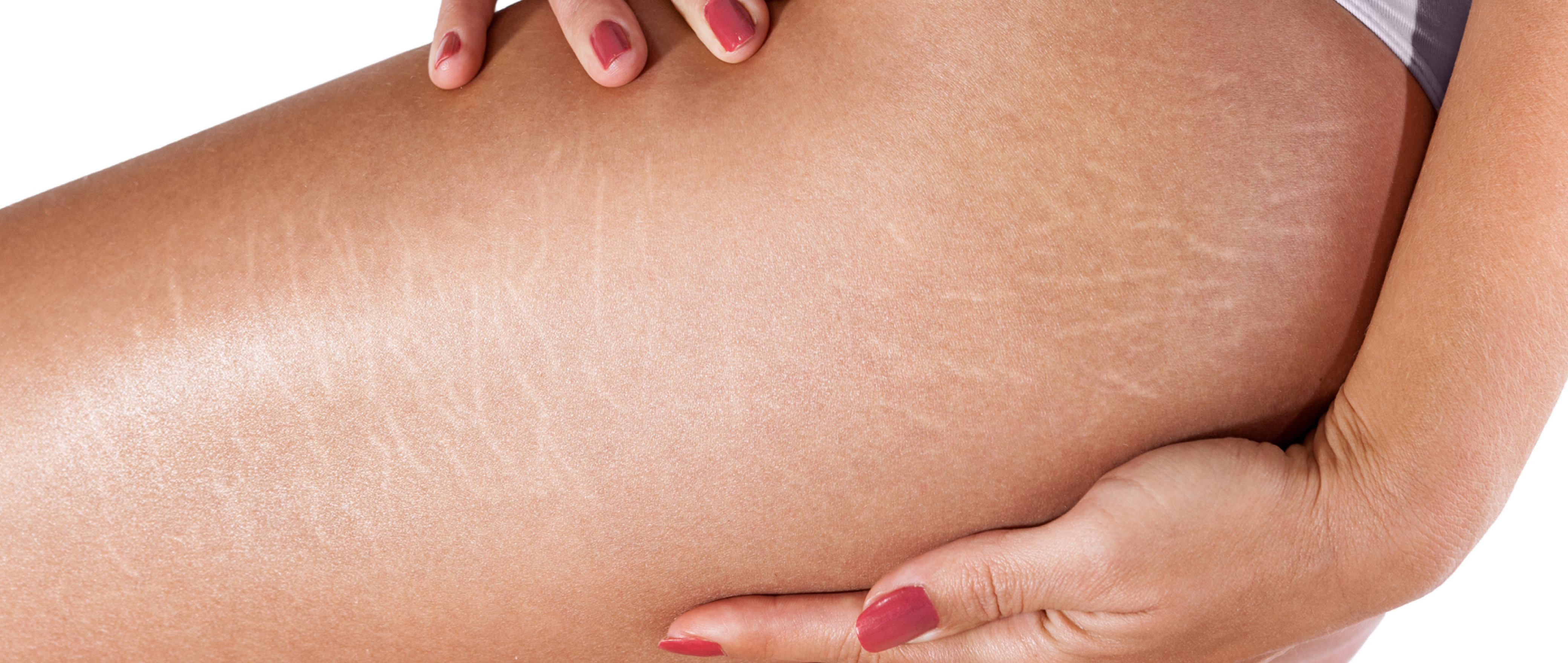 Stripes Are In: How to Care for Stretch Marks With Pride