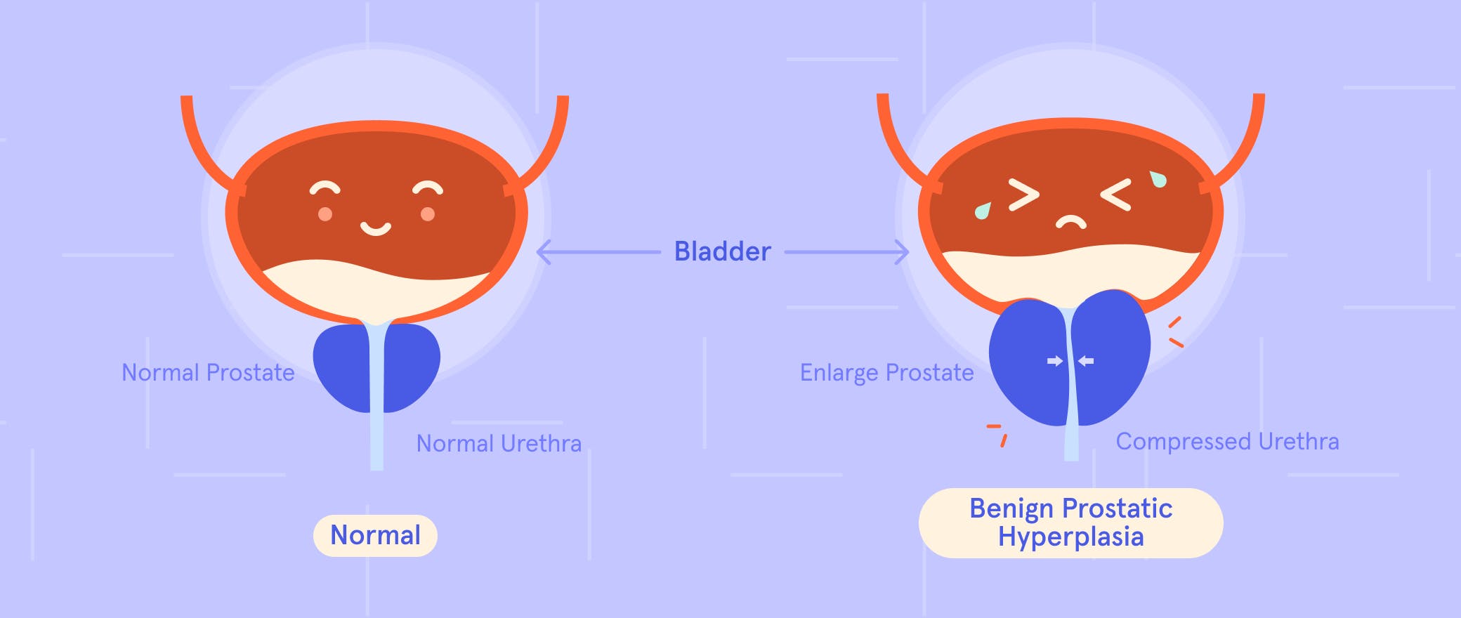 Is It Just a Peeing Problem or a Prostate Issue? Let’s Demystify BPH