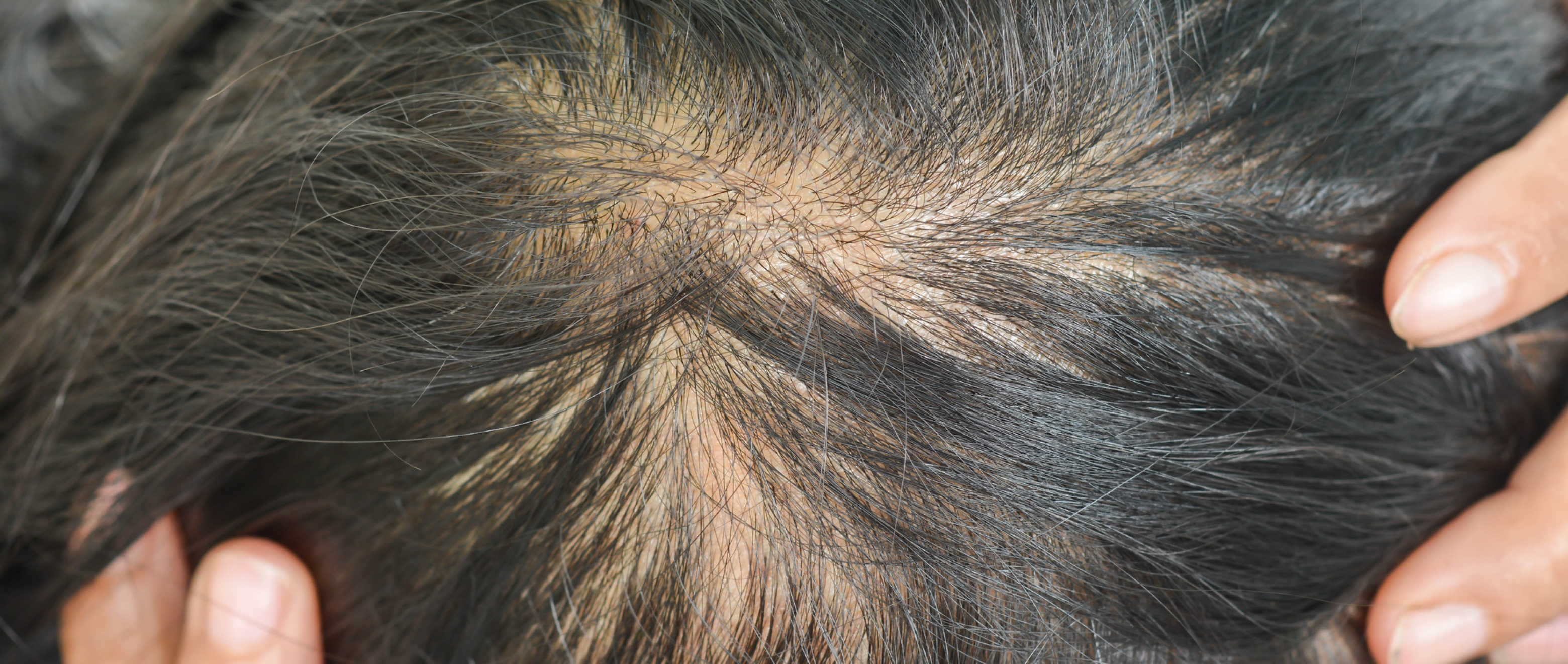 Regain Your Hair’s Glory: Combating Thinning Hair