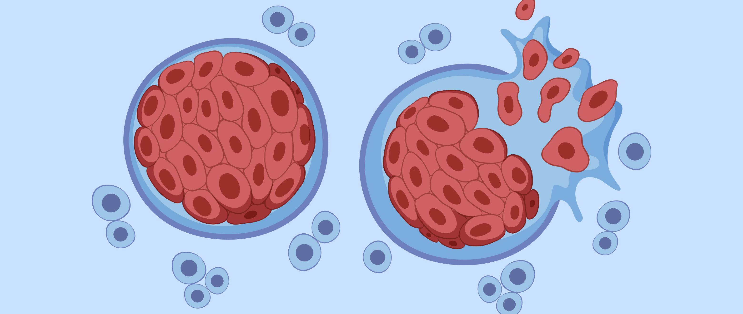 A Body on Shaky Foundations: Myeloma Explained