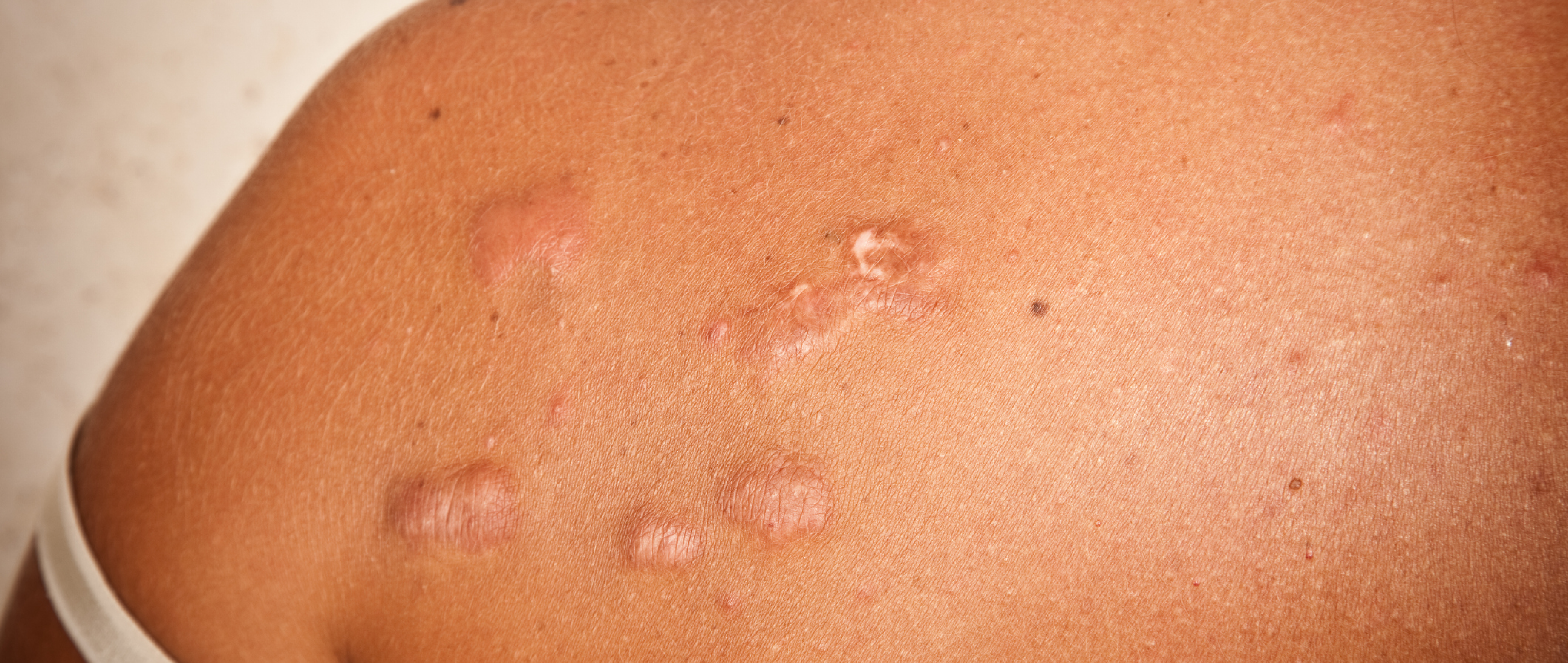 Keloid Scars: Oops, Too Much Healing!