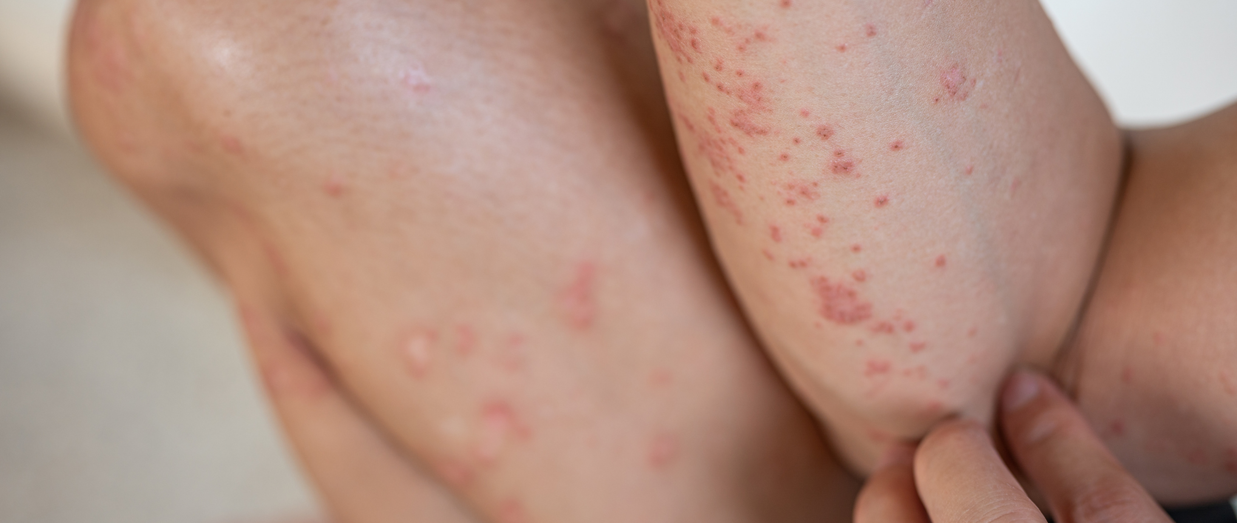 What is Lichen Planus?  