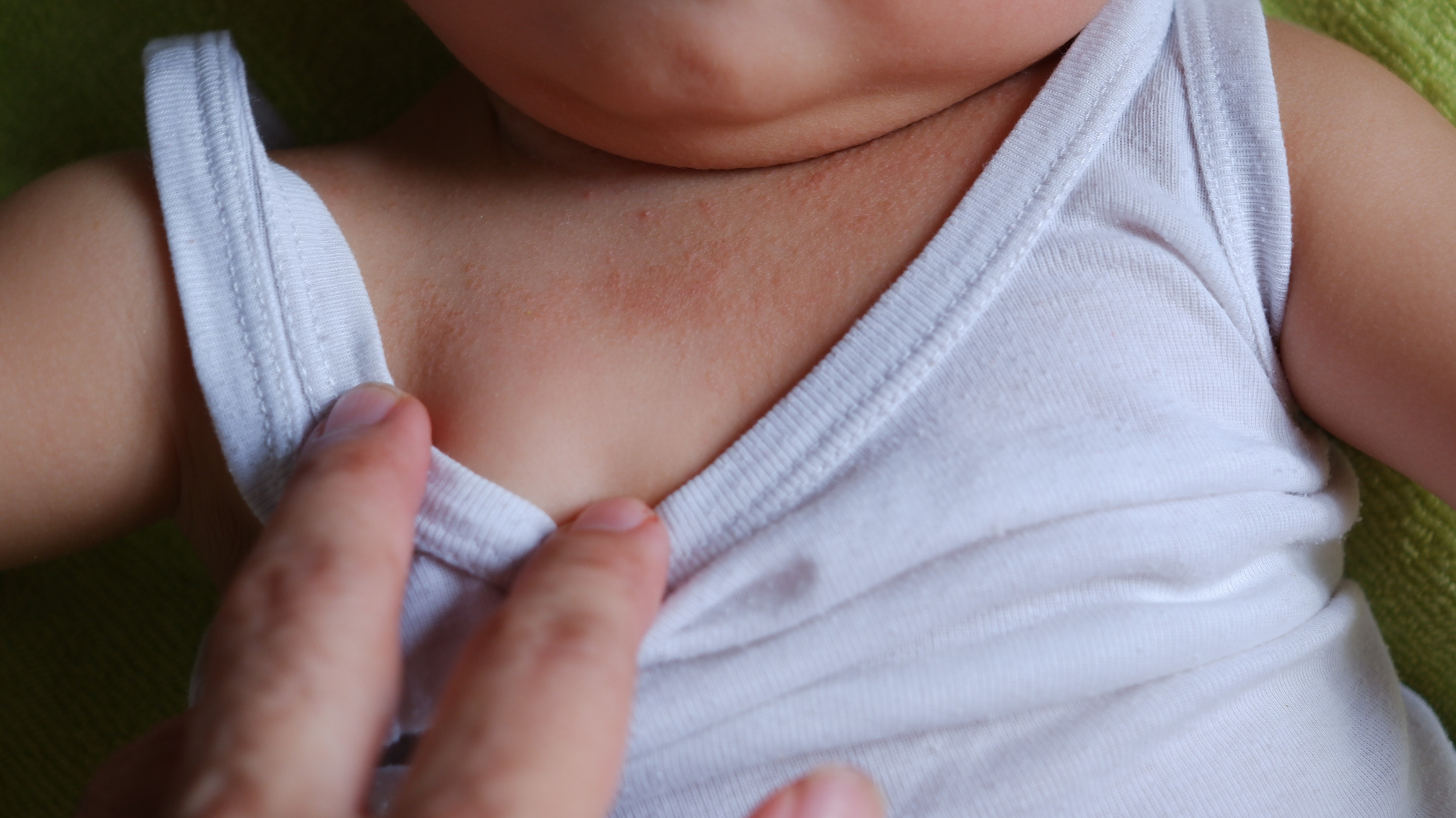 Baby Heat Rash: A Complete Guide to Identification & Management