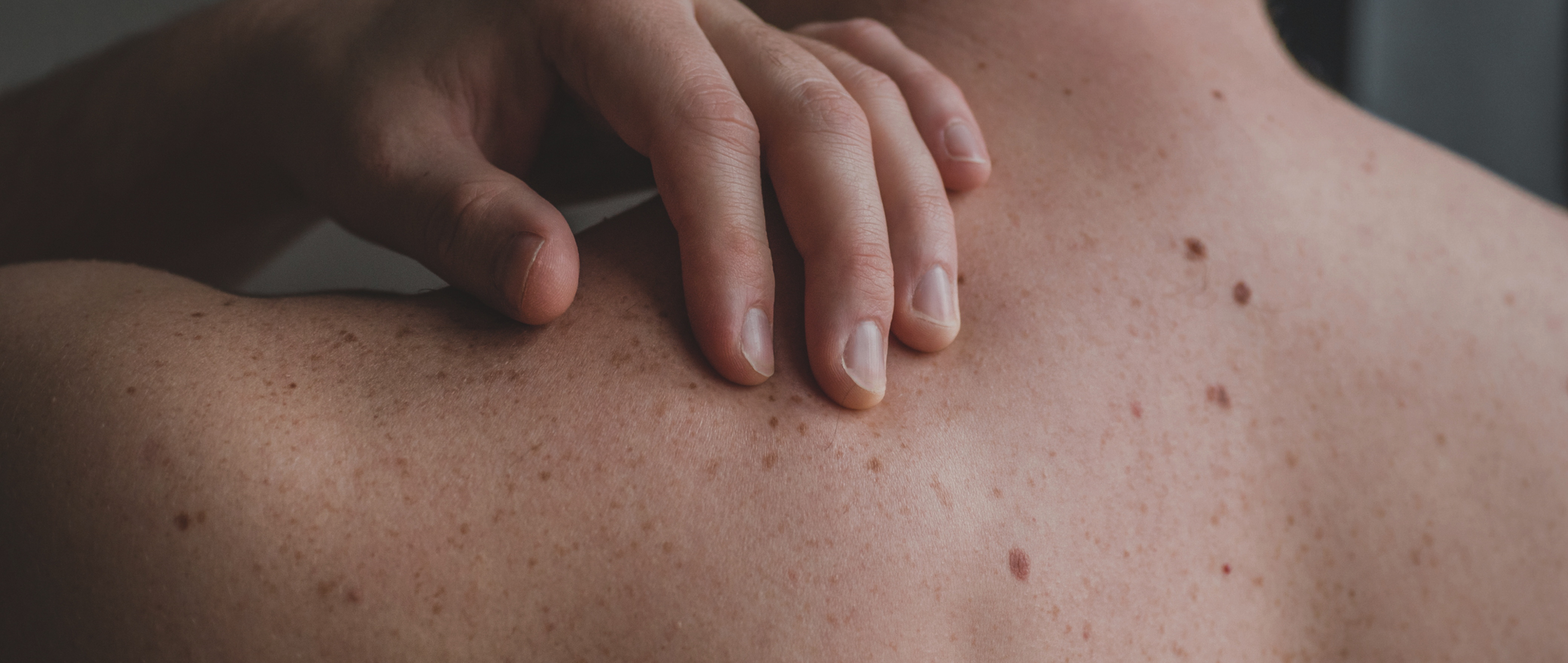 Stop, Spot & Roll? How to Handle a Suspicious Mole