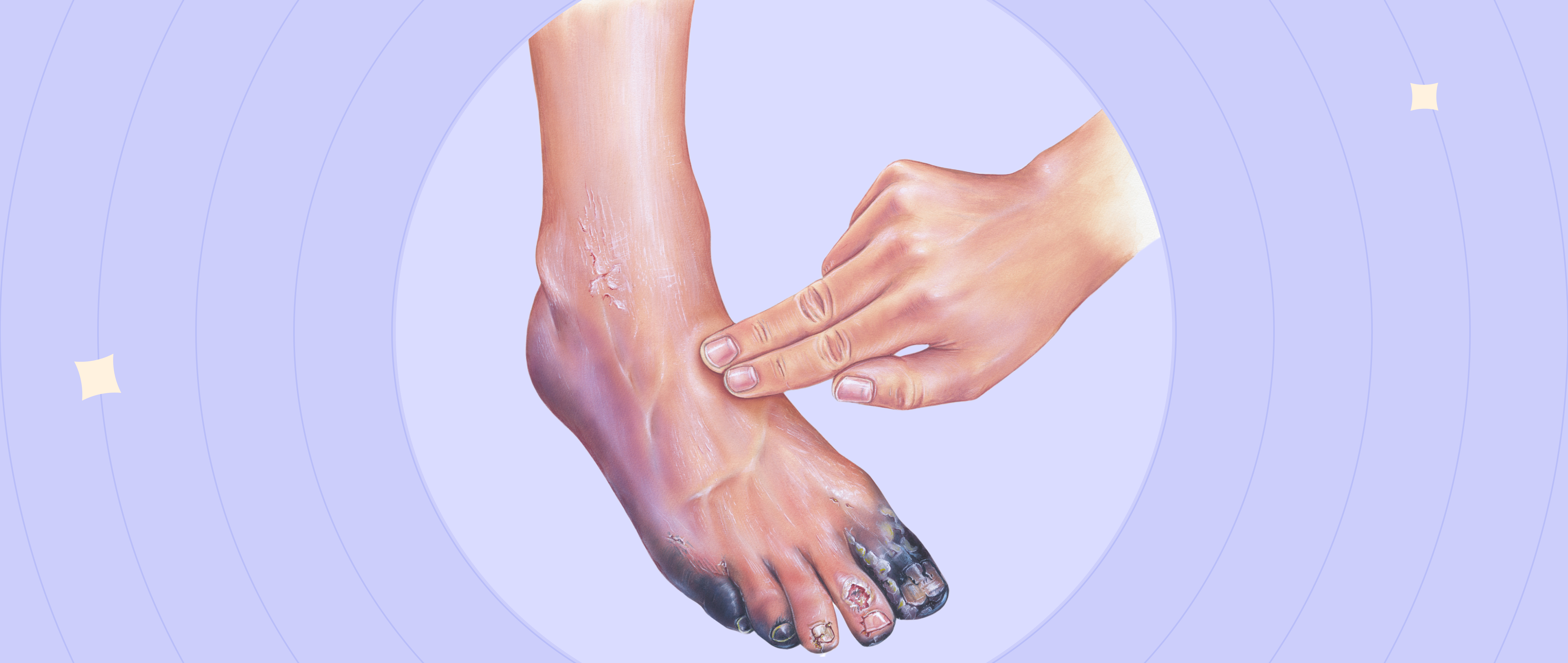 When Tissue Turns Traitor: Understanding Gangrene's Warning Signs