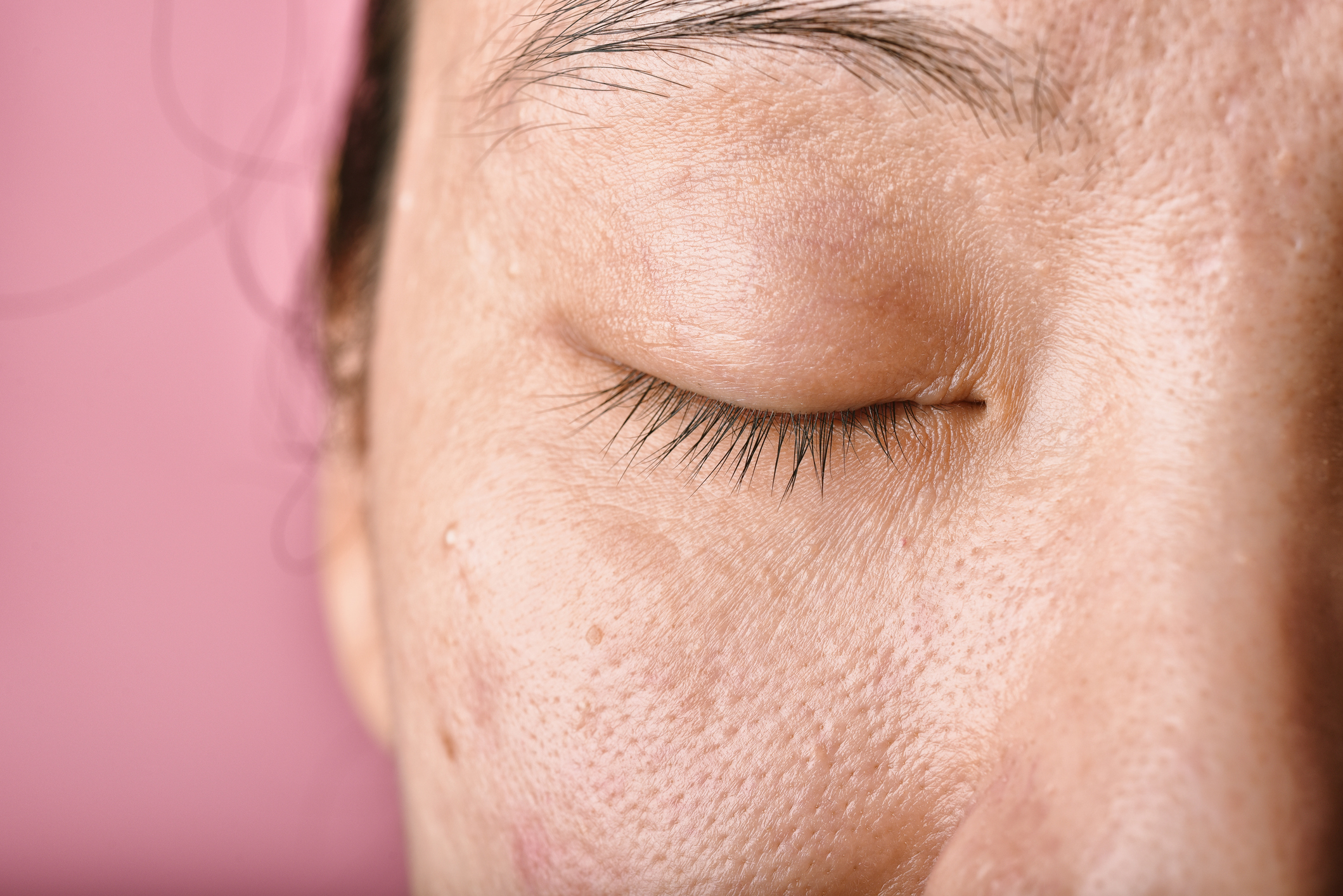 How to Remove Injury Marks from Face: Tips and Natural Remedies